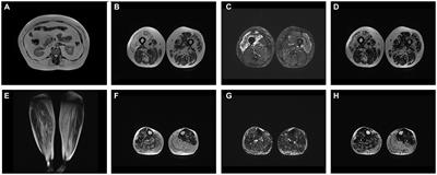 Case report of a family with hereditary inclusion body myopathy with VCP gene variant and literature review